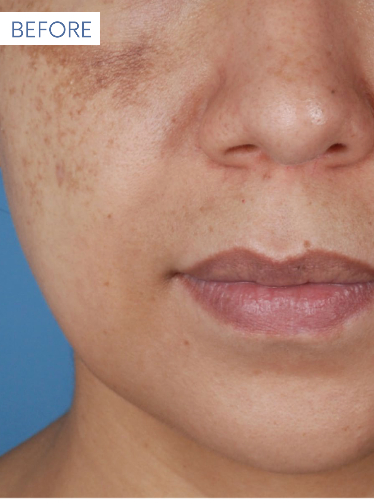 JUVEDERM 1-1