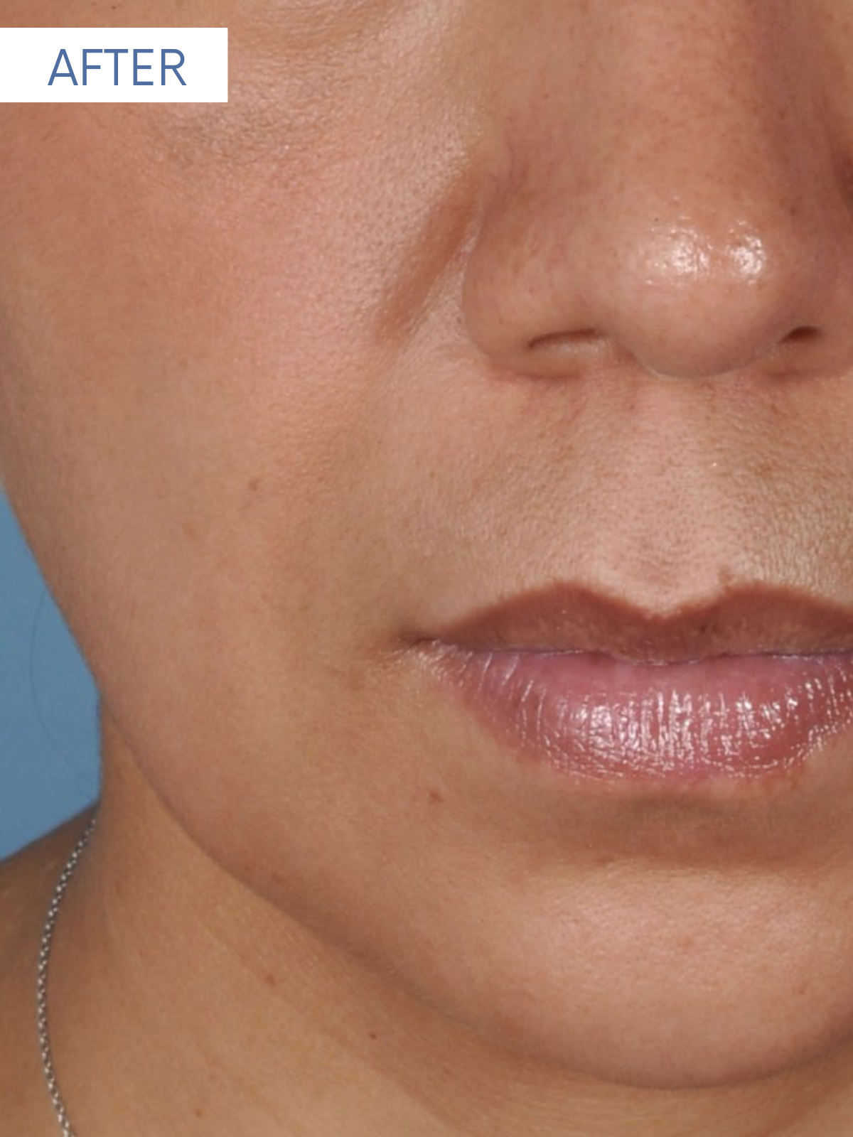 JUVEDERM 1-1 (2)