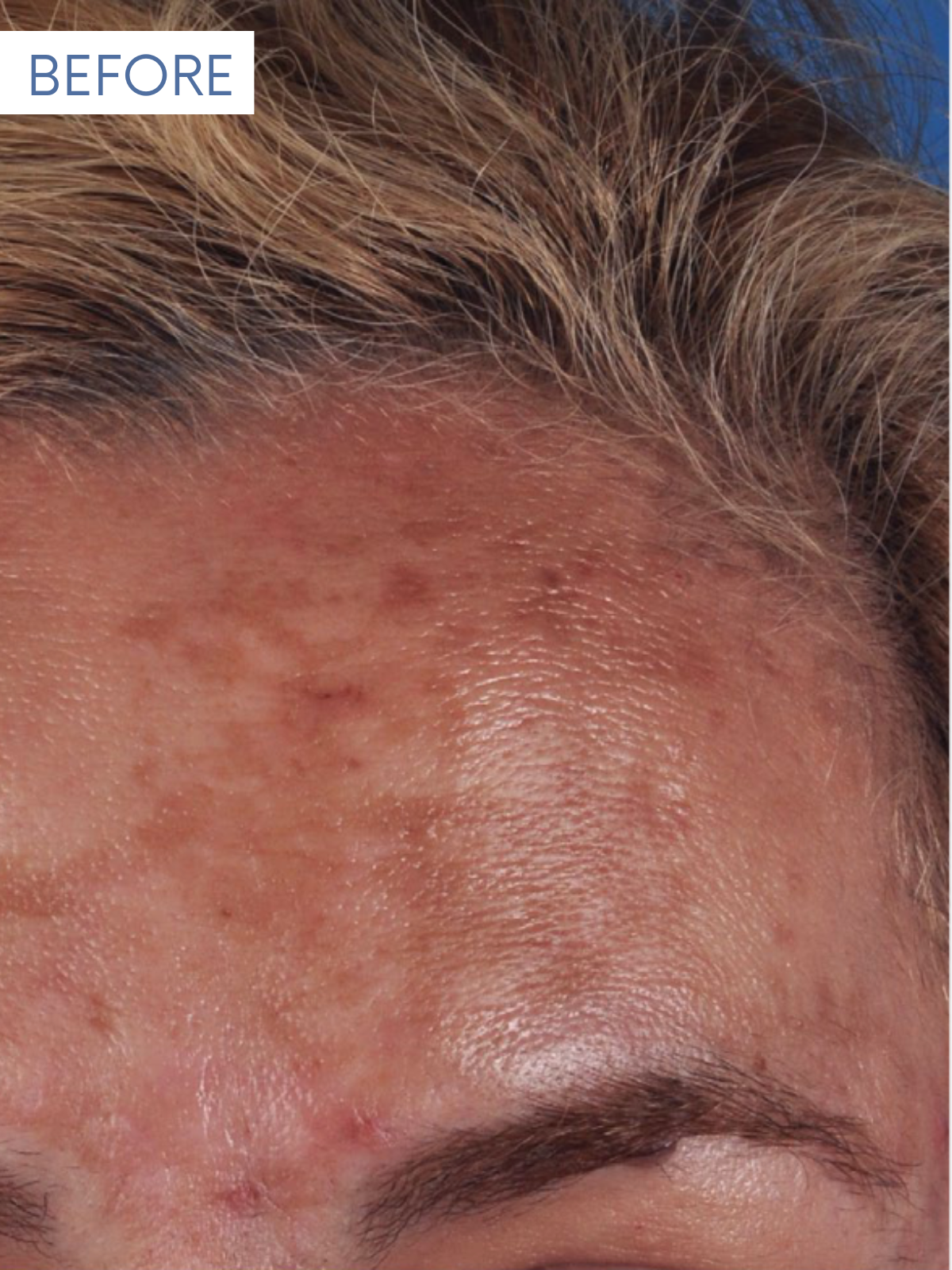 JUVEDERM 1-1 (3)