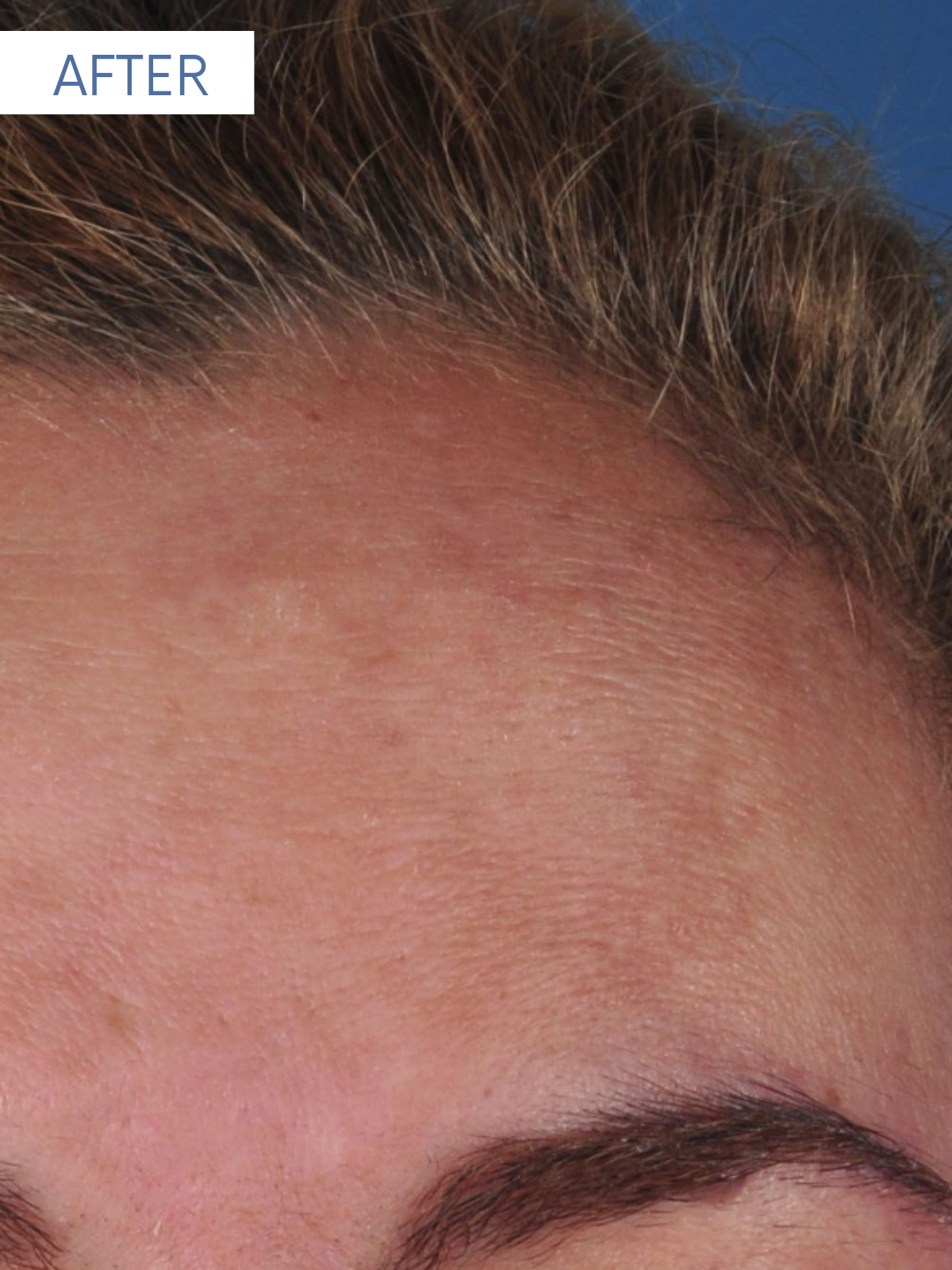 JUVEDERM 1-1 (4)