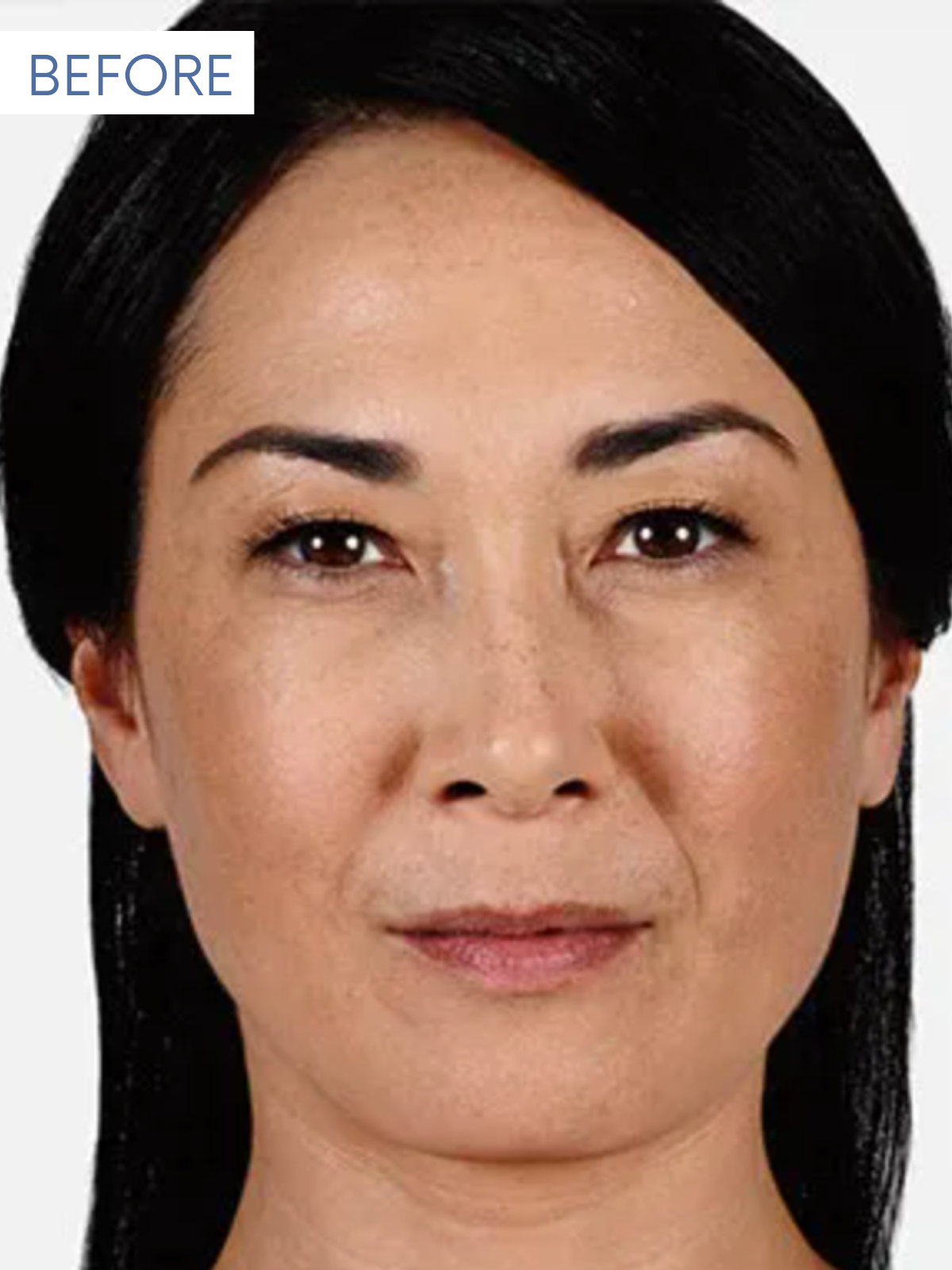 JUVEDERM 1-1