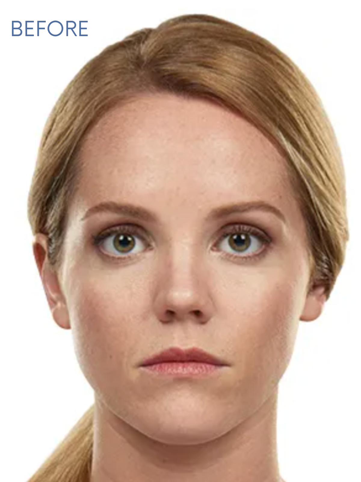 JUVEDERM 2-1 (1)