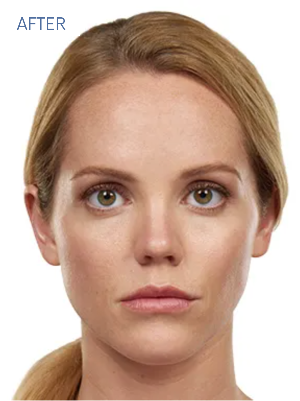 JUVEDERM 2-2