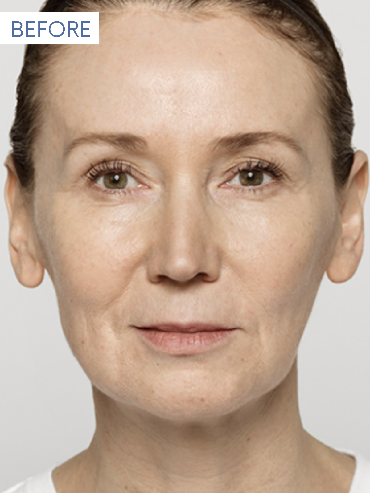 Restylane 1-1