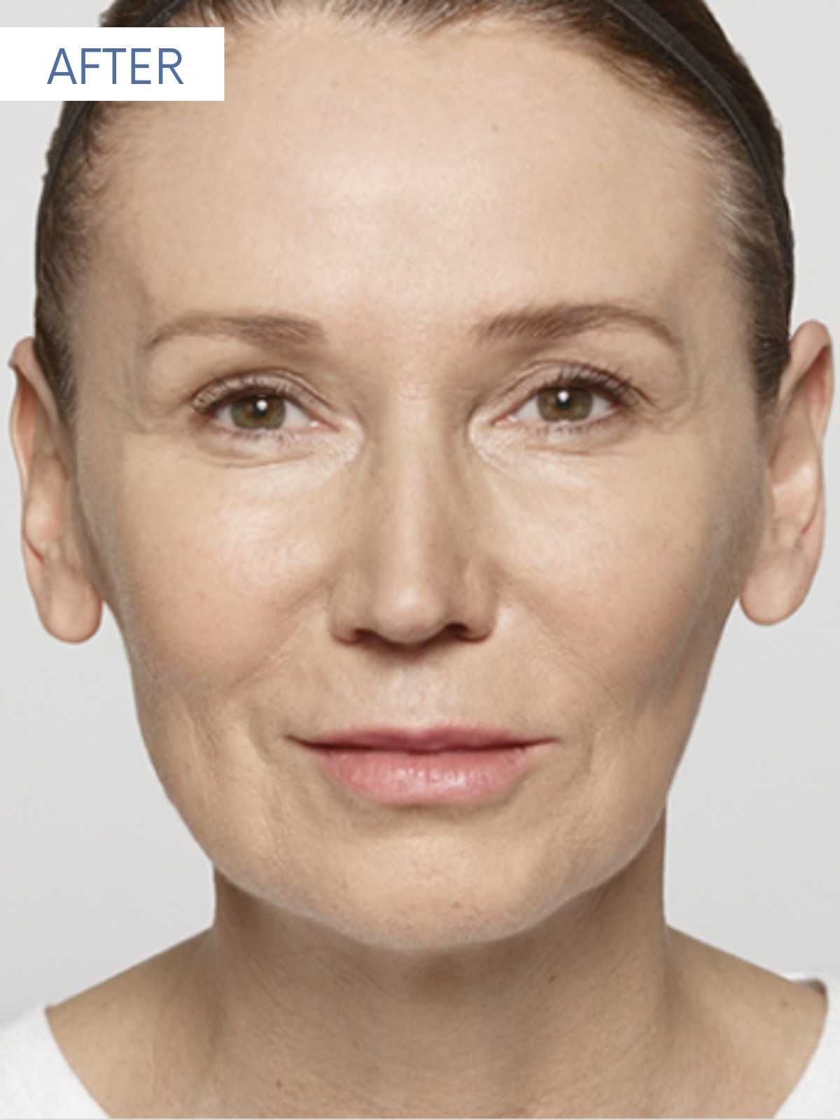 Restylane 1-2